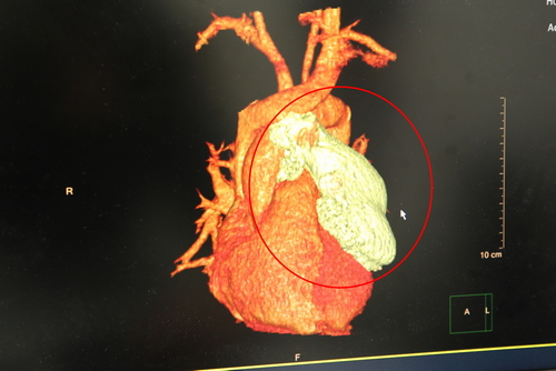 紅圈處為陳先生的胸腺瘤，已有八公分大，腫瘤非常靠近心包膜與血管
