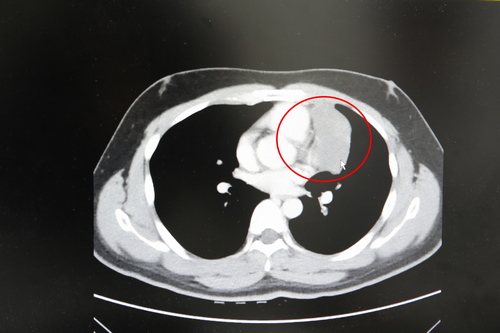 紅圈處為陳先生的胸腺瘤，已有八公分大，腫瘤非常靠近心包膜與血管