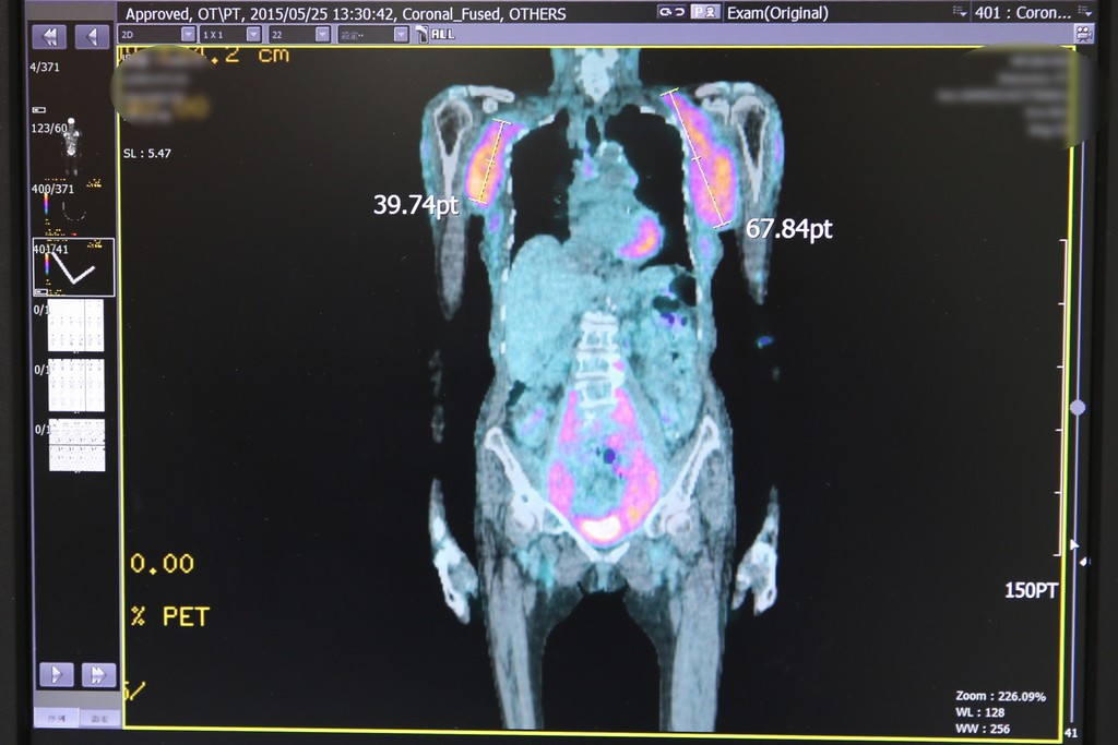 花蓮慈濟醫院血液腫瘤科醫師黃威翰表示，新型口服標靶藥物可抑制惡性B細胞生長及生存，使腫瘤縮小甚至消失，且副作用小
