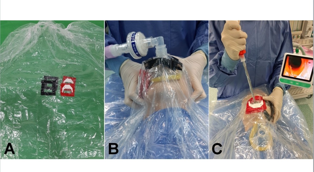 防疫罩的主體是雙層的防水塑膠布，設有獨立的呼吸器位置與插管位置，有效保障醫護人員