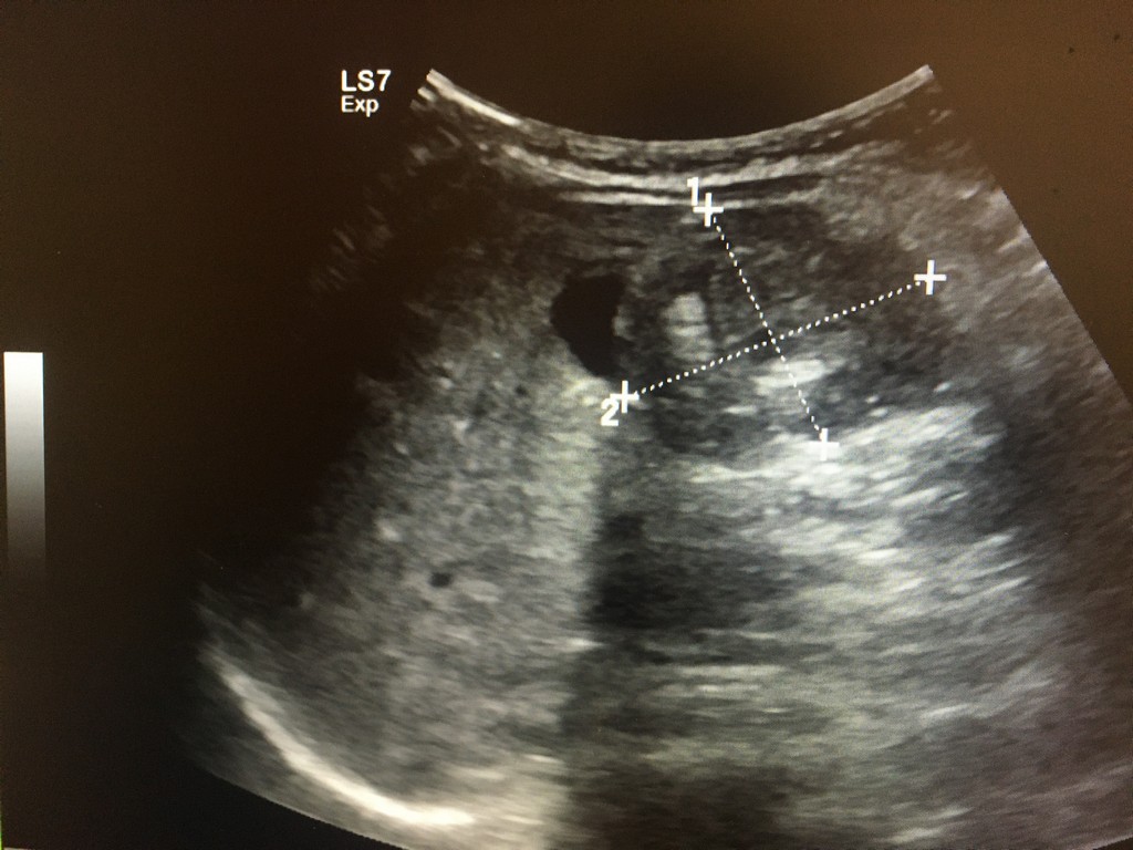 張雲傑醫師從超音波檢查發現腸套疊