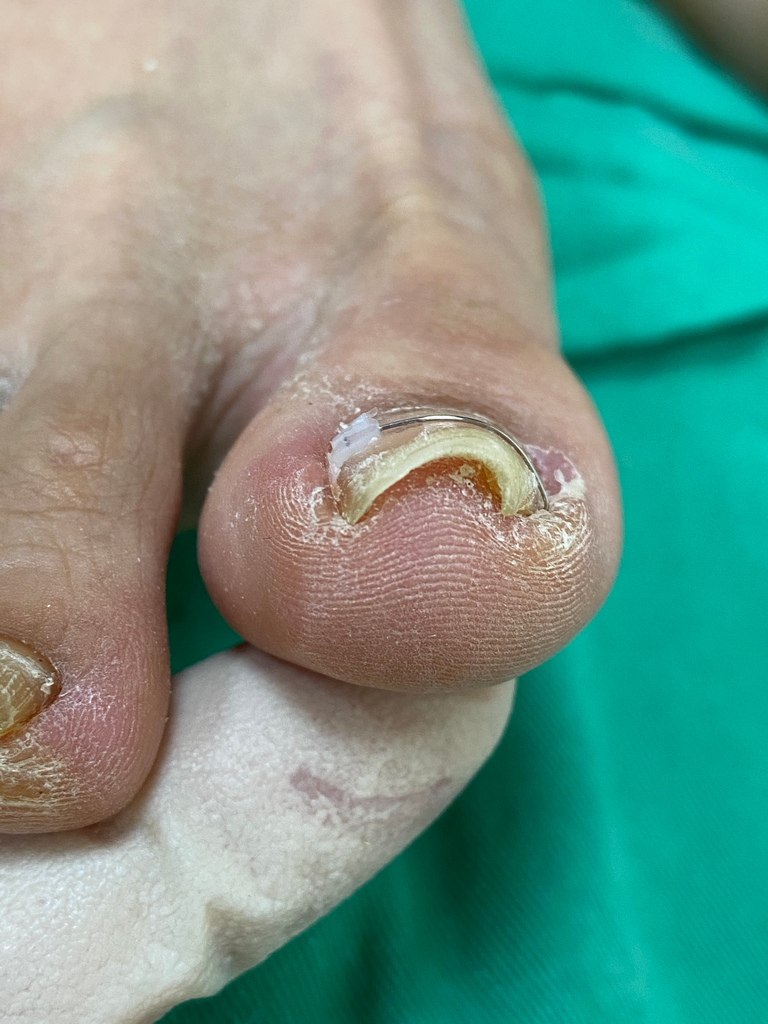 花蓮慈院皮膚科團隊為東部地區民眾，引進新式的矯正方式