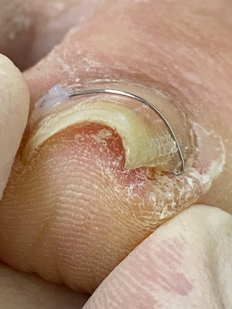 花蓮慈院皮膚科團隊為東部地區民眾,引進新式的矯正方式 花蓮慈院皮膚科團隊為東部地區民眾,引進新式的矯正方式