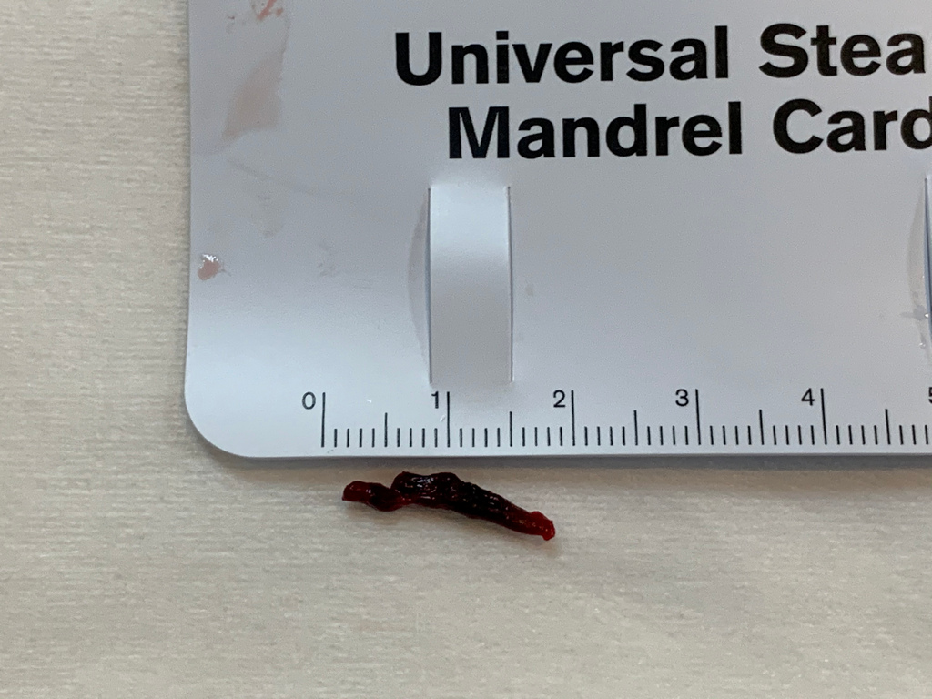 阮郁修主任為蕭先生執行腦動脈內取栓,以導管從鼠蹊部的股動脈進入到腦部的基底動脈,2 0分鐘就成功取出兩公分的血栓,打通病人阻塞的腦血管 阮郁修主任為蕭先生執行腦動脈內取栓,以導管從鼠蹊部的股動脈進入到腦部的基底動脈,2 0分鐘就成功取出兩公分的血栓,打通病人阻塞的腦血管