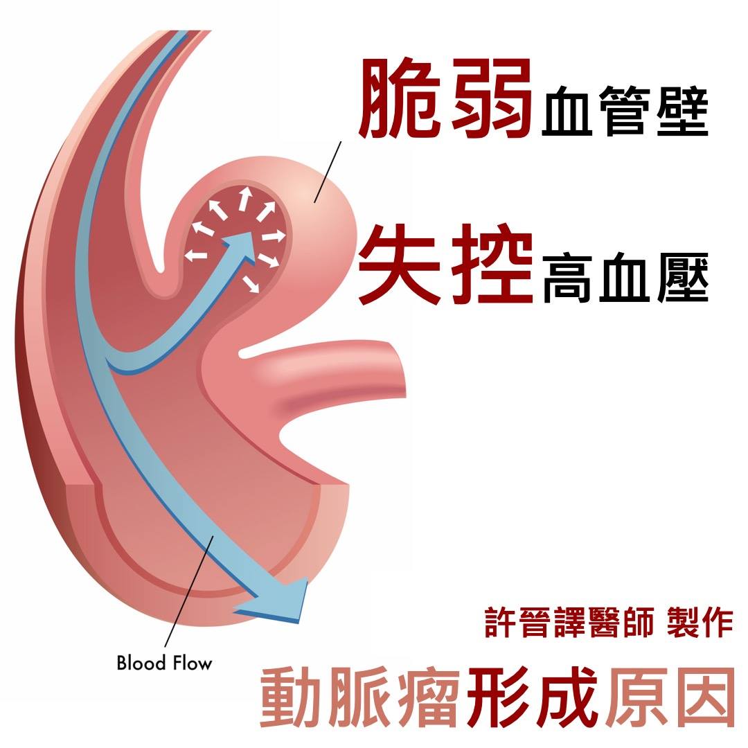 花蓮慈院高齡整合照護科主治醫師許晉譯分享動脈瘤形成的主要原因。