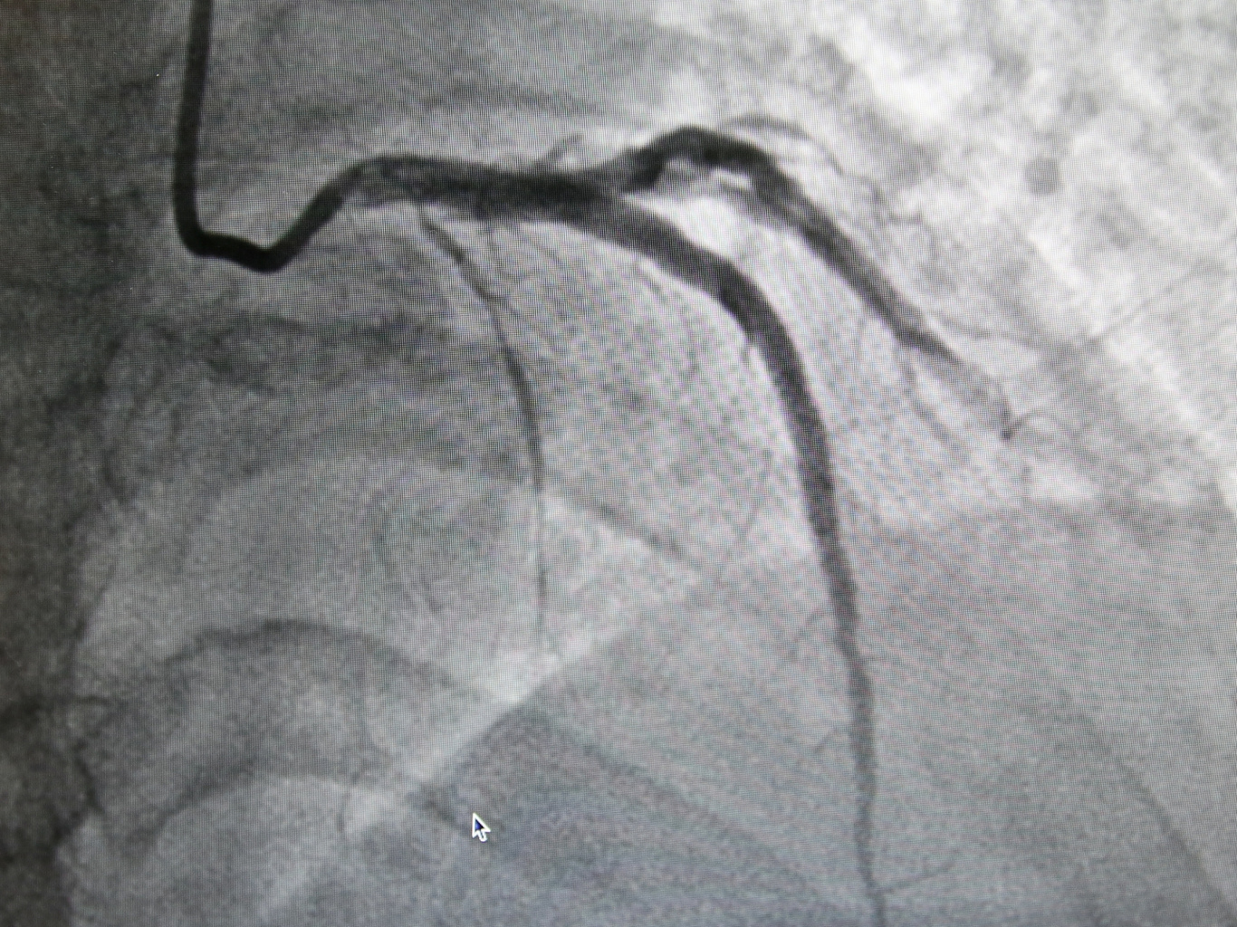 置放冠狀動脈血管支架之後，血流恢復正常。