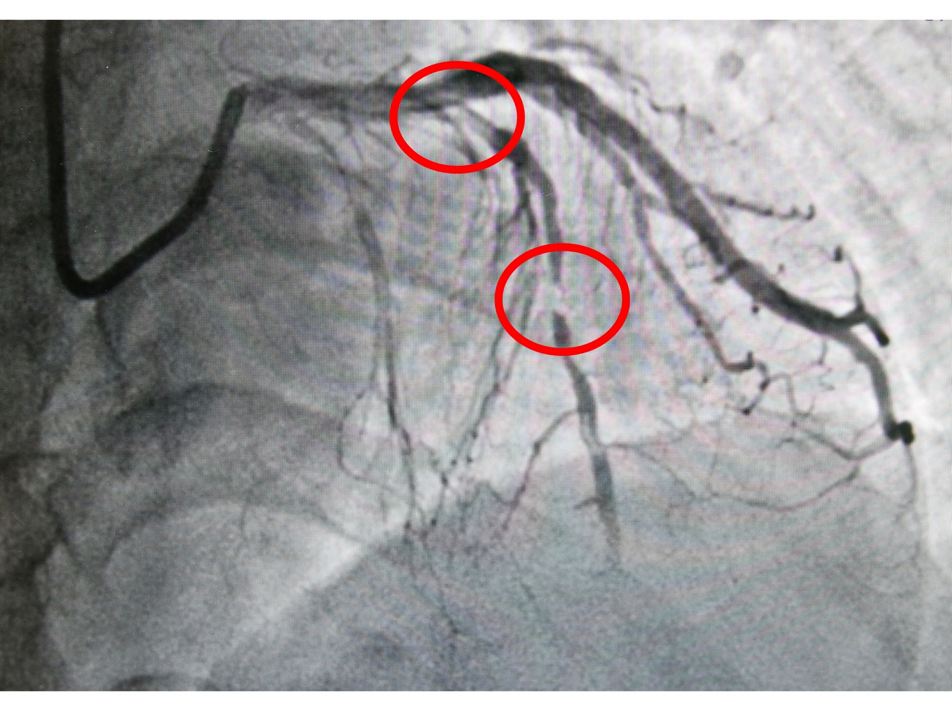 透過心導管檢查，可以發現張女士冠狀動脈血管中的左前降支出現阻塞。(紅圈處)