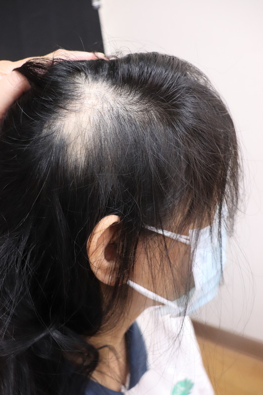 施打COVID疫苗後一周後掉髮-圓形禿