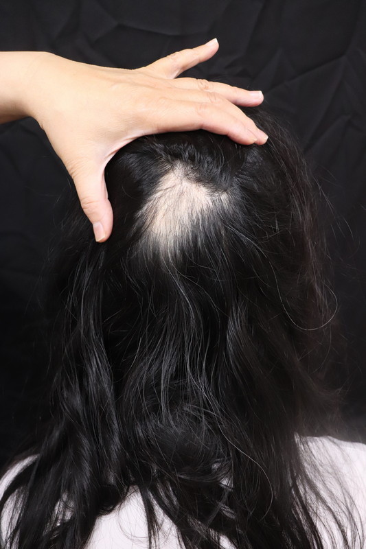 施打COVID疫苗後一周後掉髮-圓形禿