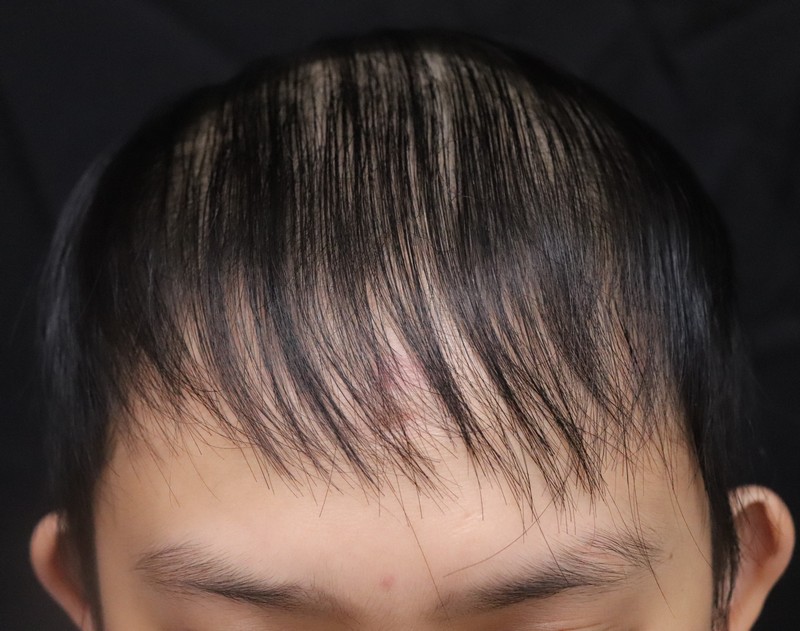 施打COVID-19疫苗一周後出現瀰漫性掉髮