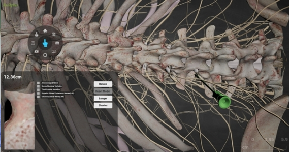 花蓮慈院骨科部葉光庭副主任透過AR眼鏡，可以直接在無語良師的身體上看見神經與血管的位置，降低脊椎手術的風險