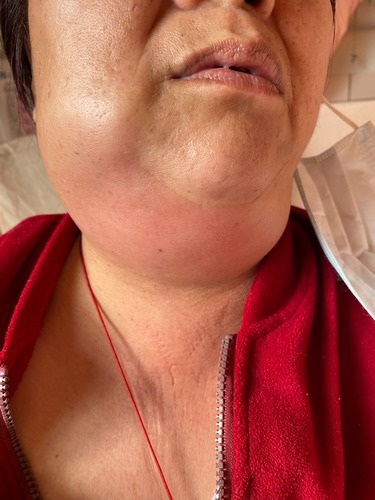 年近五旬鄭女士，拔牙後發燒、頸部腫痛，到花蓮慈濟醫院急診就醫，確診後為深頸部感染，致死率高達五成