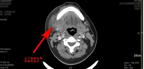 深頸部感染電腦斷層影像