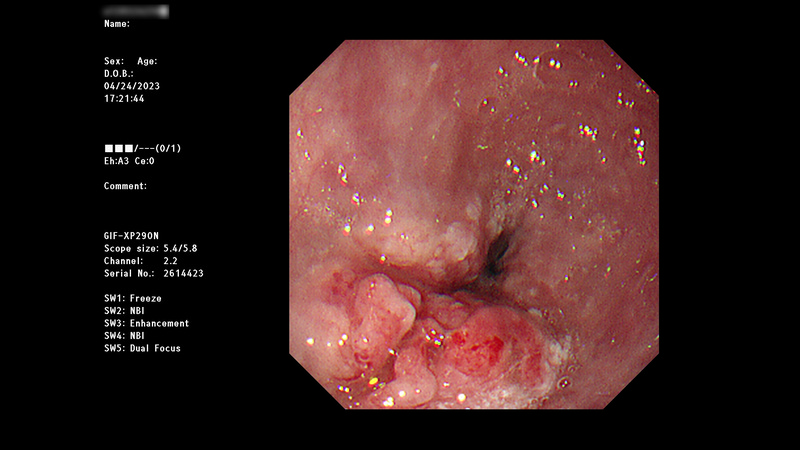 sss1放化療前上消化道鏡檢 食道中下段腫瘤