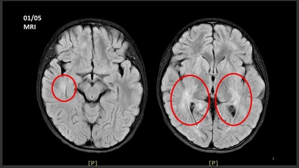 七歲女童頭痛、耳鳴　竟是罕見自體免疫神經發炎