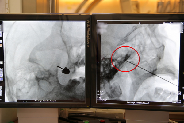 麻醉部疼痛科主任王柏凱使用高頻熱凝療法將電擊針深入至三叉神經的神經節治療