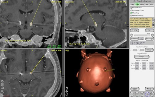 2015/08/10～12花蓮慈濟醫院日誌─ ─聽細胞在說話　鄭大耿DBS深部腦刺激手術圓滿