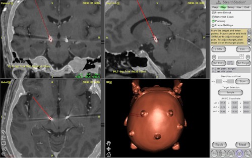 2015/08/10～12花蓮慈濟醫院日誌─ ─聽細胞在說話　鄭大耿DBS深部腦刺激手術圓滿