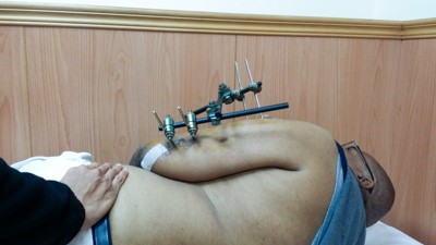 流彈波及忍痛數月 海地志工丹尼爾跨海就醫解病苦