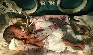 百里牽掛 因愛無距（早產兒宥宥的故事）