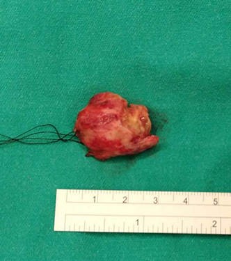 2017/12/23 花蓮慈院《真實之路，感恩有您》溫馨座談日誌(七之四) ─ ─明察秋毫拔除眼中釘　三十來年的第一張自拍照