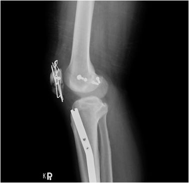 2017/12/23 花蓮慈院《真實之路，感恩有您》溫馨座談日誌(七之二) ─ ─ 異鄉車禍徬徨無助　「鄺」世妙手細心拚骨（文/黃思齊）
