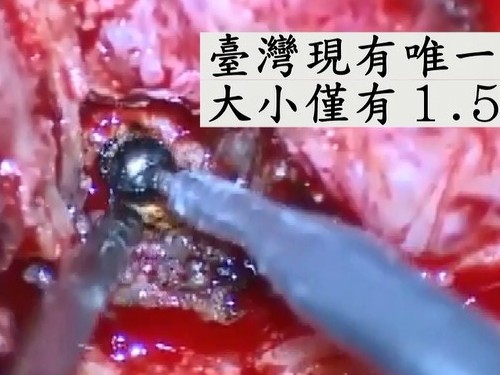 2017/12/23 花蓮慈院《真實之路，感恩有您》溫馨座談日誌(七之四) ─ ─明察秋毫拔除眼中釘　三十來年的第一張自拍照