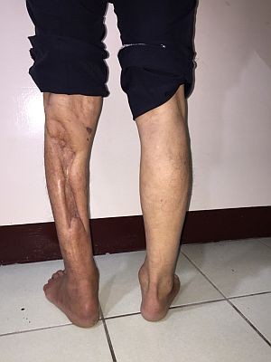 2017/12/23 花蓮慈院《真實之路，感恩有您》溫馨座談日誌(七之三) ─ ─ 如假包換真腳義肢　張國森越走越穩感恩鄭醫師（文/游繡華）