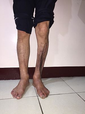 2017/12/23 花蓮慈院《真實之路，感恩有您》溫馨座談日誌(七之三) ─ ─ 如假包換真腳義肢　張國森越走越穩感恩鄭醫師（文/游繡華）