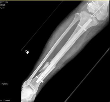 2017/12/23 花蓮慈院《真實之路，感恩有您》溫馨座談日誌(七之二) ─ ─ 異鄉車禍徬徨無助　「鄺」世妙手細心拚骨（文/黃思齊）