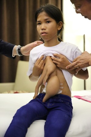 2018/08/30花蓮慈濟醫院日誌——菲律賓不對稱萎縮型連體嬰醫療會議　人醫群策妙手妙法（文／江家瑜）　