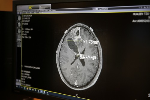 2019/06/28花蓮慈濟醫院日誌——與惡性腦瘤奮戰 神外團隊妙手回春守護愛