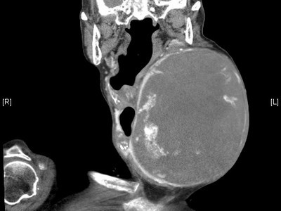 罕見巨大腫瘤摘除 八十七歲老婦重展笑顏