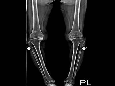 術前，健康膝蓋頂端會呈現圓弧狀，孫女士的則已嚴重磨損、磨平，且雙腿呈現向外彎曲約二十度Ｏ型腿狀