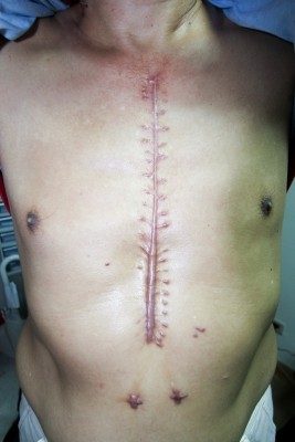 二尖瓣腱索斷裂　微創開心手術恢復快