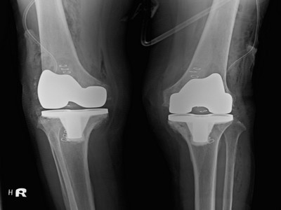 孫女士接受「微創式人工膝關節置換手術」後的雙膝狀況。