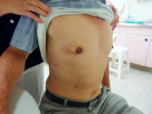 二尖瓣腱索斷裂　微創開心手術恢復快