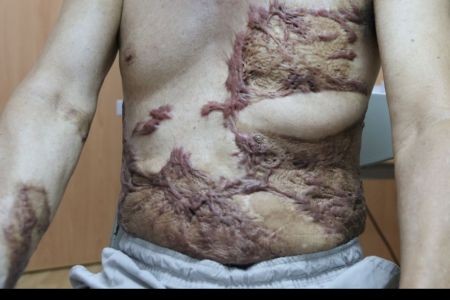 讓「壓力」成為助力 燒燙傷患者復健重生