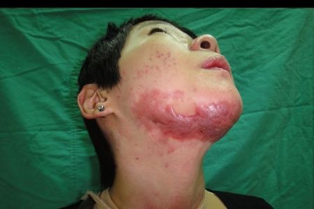 讓「壓力」成為助力 燒燙傷患者復健重生