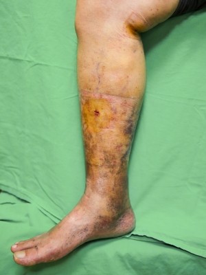 靜脈曲張爬上腿　雷射微創手術傷口小