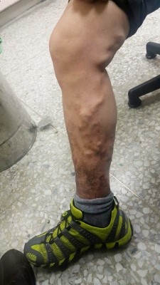 靜脈曲張爬上腿　雷射微創手術傷口小