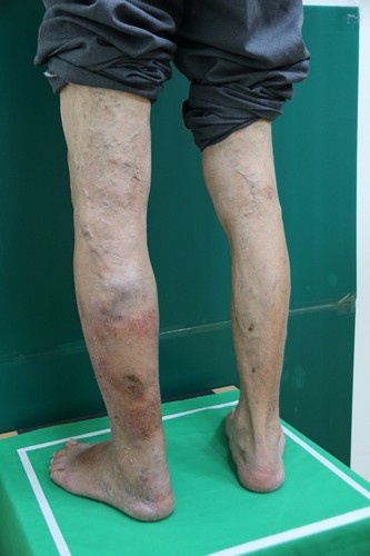 靜脈曲張別「擺爛」　嚴重血栓性靜脈炎可能會肺栓塞