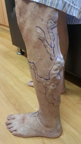 靜脈曲張別「擺爛」　嚴重血栓性靜脈炎可能會肺栓塞