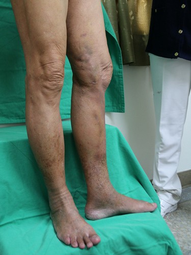 靜脈曲張別「擺爛」　嚴重血栓性靜脈炎可能會肺栓塞