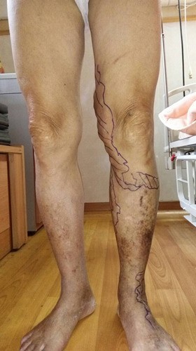 靜脈曲張別「擺爛」　嚴重血栓性靜脈炎可能會肺栓塞