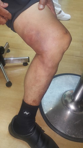 靜脈曲張別「擺爛」　嚴重血栓性靜脈炎可能會肺栓塞