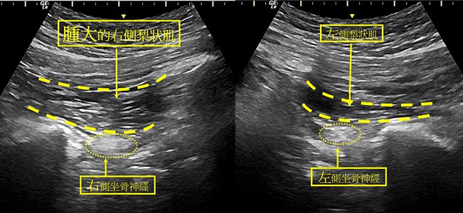 免開刀!神經阻滯治療疼痛 一針擺脫劇烈腿疼