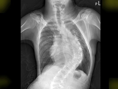 23歲25公斤罕病病患　成功重拾健康心跳