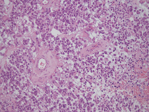 惡性腦瘤擴散 惡性腦瘤擴散