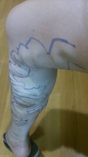 醫療與美感　超級微創雷射靜脈曲張切除手術